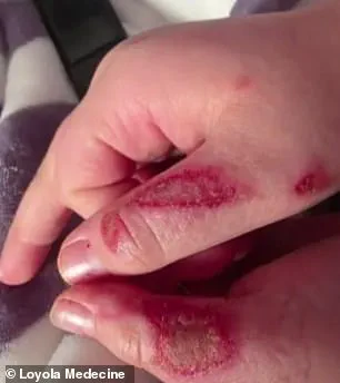 Nine-Year-Old Suffers Severe Burns in TikTok Microwave Trend Involving Needoh Cube