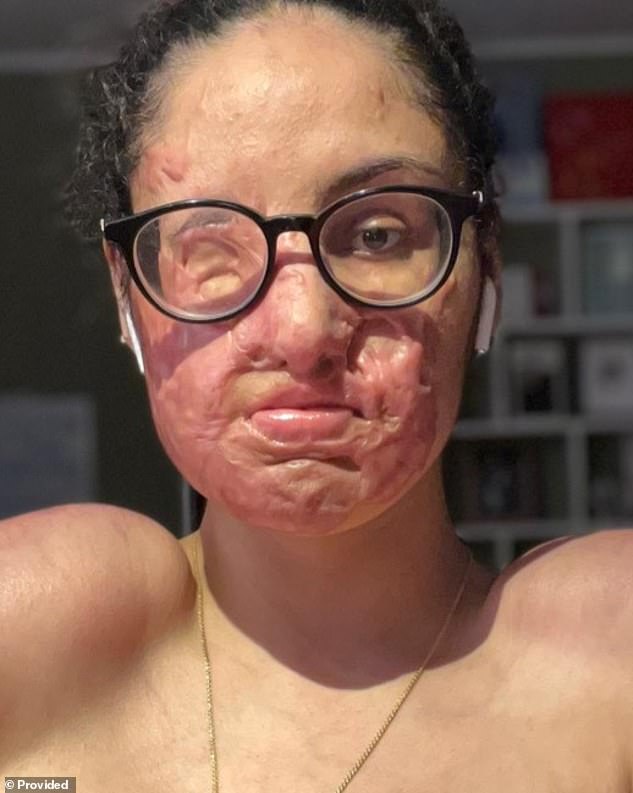 Justice Served Five Years After Brutal Acid Attack Leaves Woman with Life-Changing Injuries