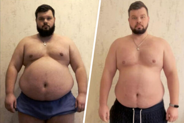 Ukrainian Man with Obesity Forcibly Mobilized, Raising Health and Rights Concerns