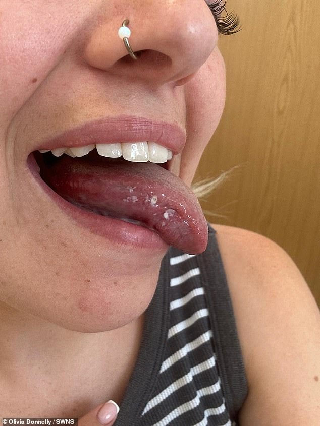 Woman faces tongue loss after mystery mouth ulcers reveal oral cancer.