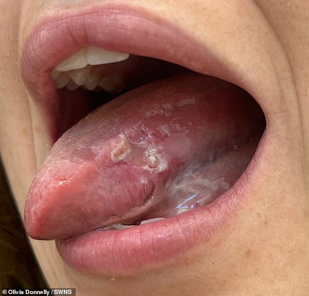 Woman faces tongue loss after mystery mouth ulcers reveal oral cancer.