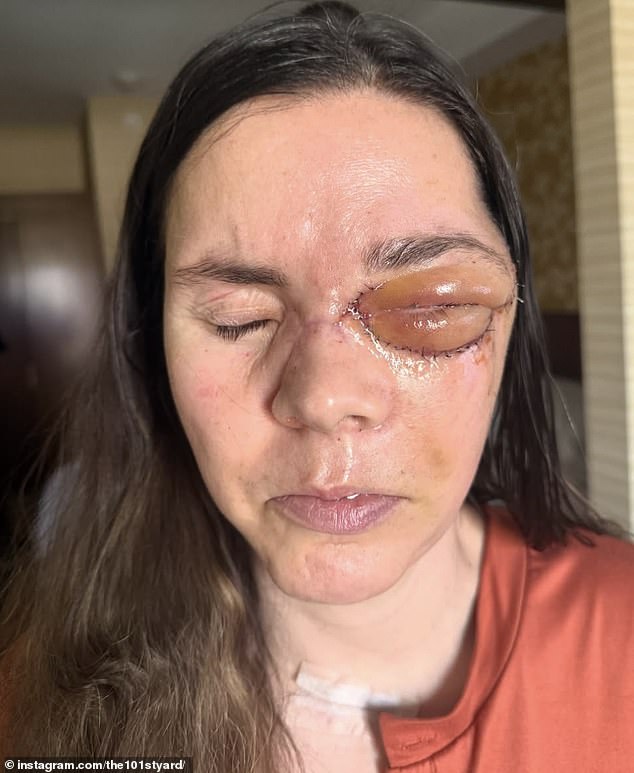 Kenai mother reveals devastating injuries eight months after bear mauling