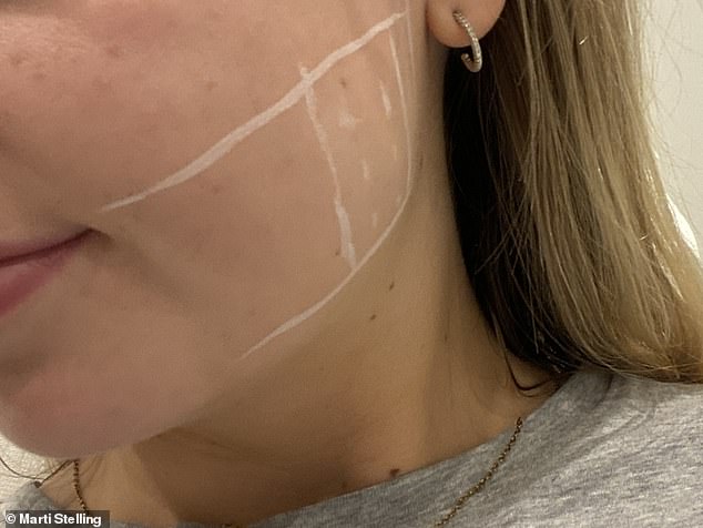 Young woman turns to masseter Botox to stop painful sleep grinding.