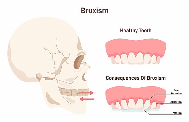 Young woman turns to masseter Botox to stop painful sleep grinding.